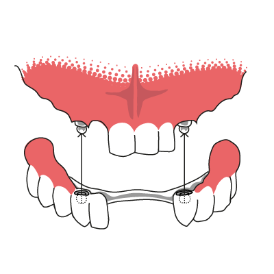 Veranschaulichung der Funktionsweise einer Druckknopfprothese, die auf Zahnstümpfen befestigt wird.