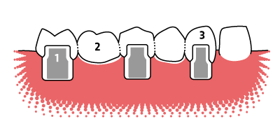 Veranschaulichung von Aufbau und Funktionsweise einer 5-gliedrigen Zahnbrücke