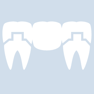 Abbildung einer Zahn-Brücke